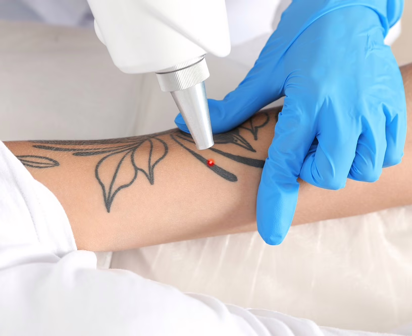 eliminar tatuaje laser